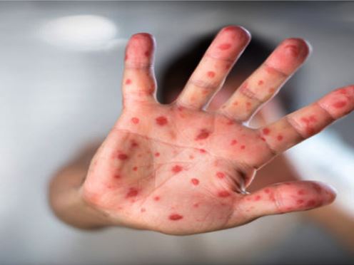 நாட்டில் அதிகமான சிறுவர்களுக்கு தொழுநோய்